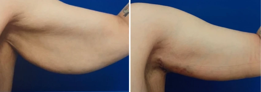 Arm Lift - Case 1