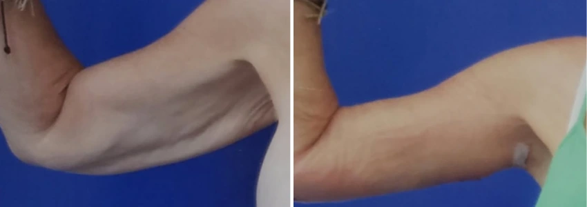 Arm Lift - Case 2 (2)