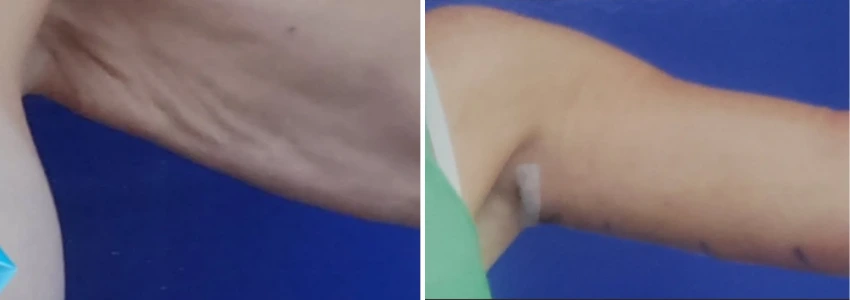 Arm Lift - Case 2