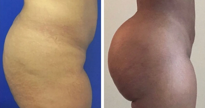 BBL - Lipo - 2