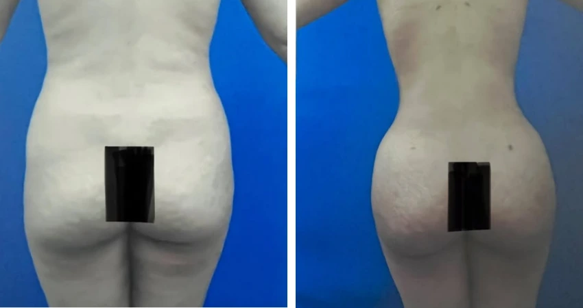 BBL - Lipo - 2 (2)