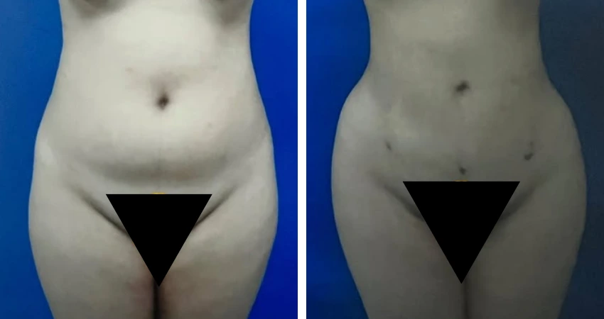 BBL - Lipo - 2