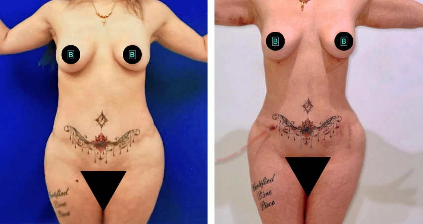 Biopolymer Excision, Lipo 360, w_Ultrasound, Guided BBL Reconstruction (2)