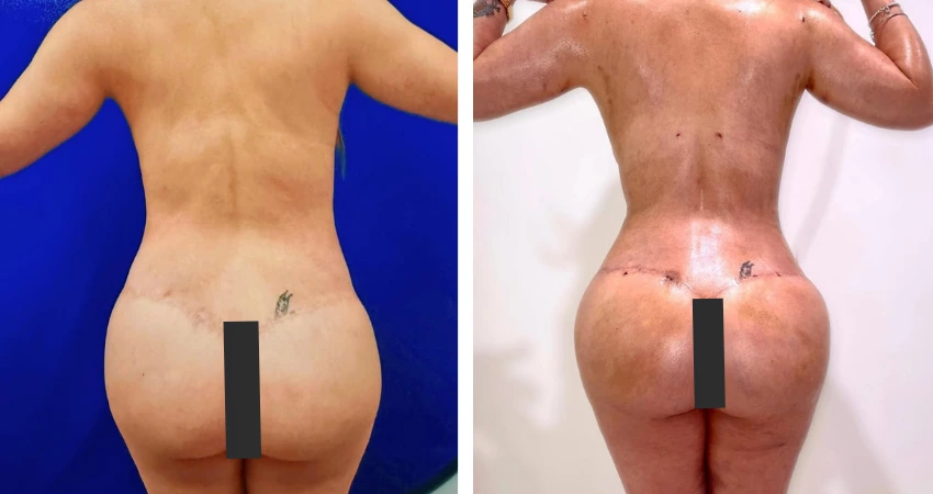 Biopolymer Excision, Lipo 360, w_Ultrasound, Guided BBL Reconstruction