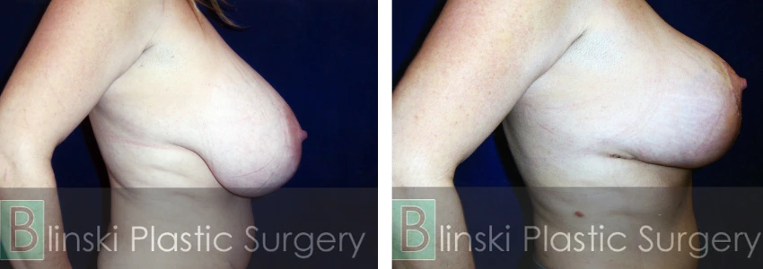 Breast 1 - Breast Lift