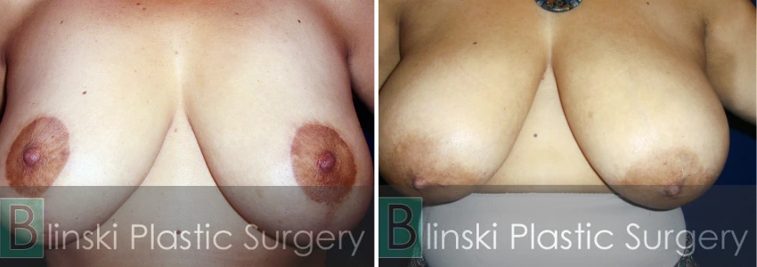 Breast 3