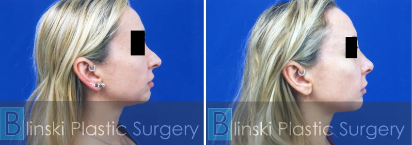 Rhinoplasty 2
