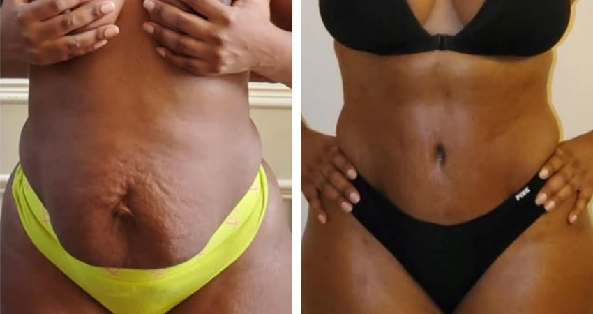 Tummy Tuck - Case 3
