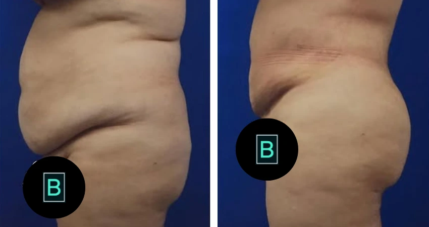 360liposuction (2)