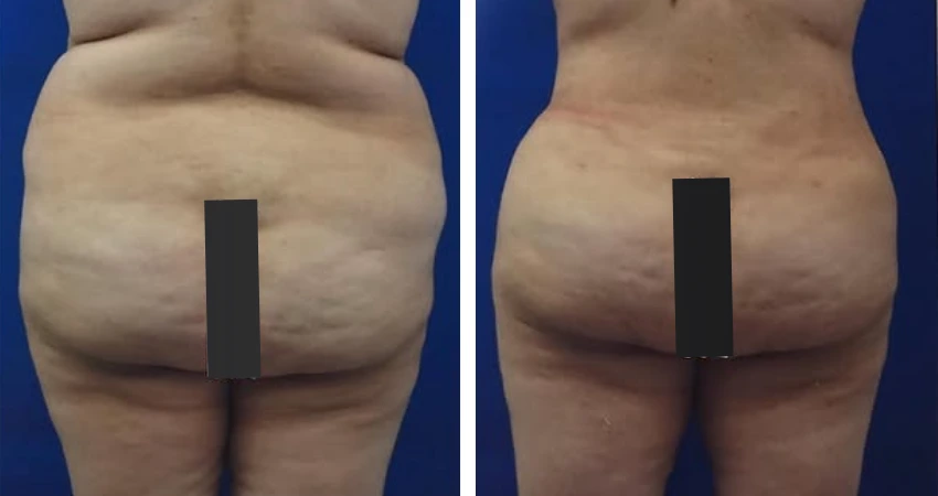 360liposuction (3)