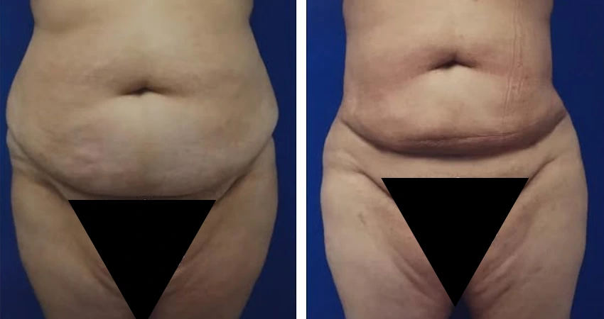 360liposuction