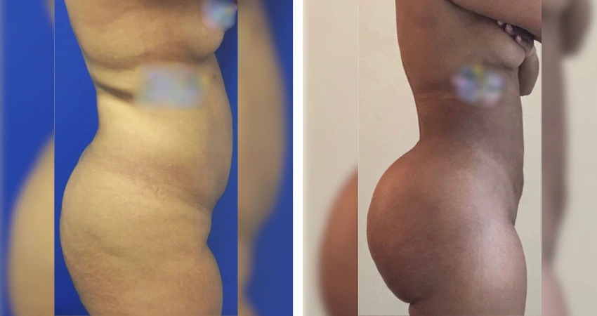 BBL - Lipo