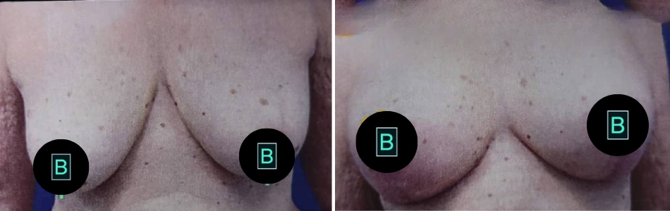 Full breast lift fat graft