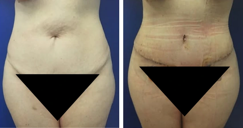 Tummy tuck + BBL (2)