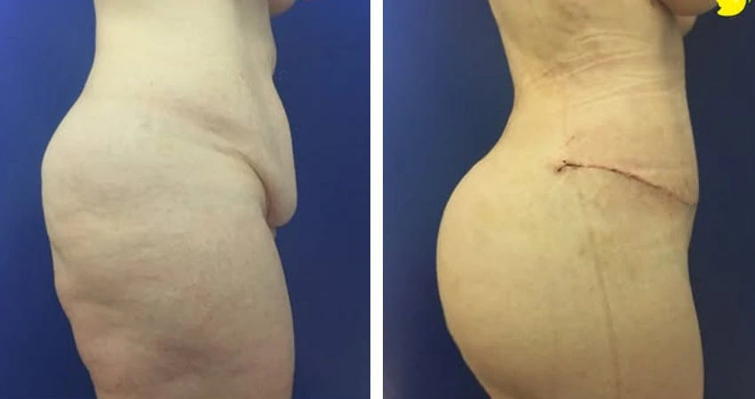 Tummy tuck + BBL
