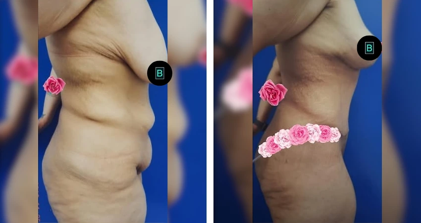 Tummy Tuck - Lipo - Breast Lift (2)